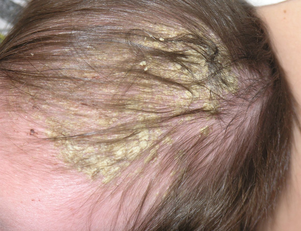 Cradle Cap on Babies Scalp Program – Scalp & Hair Loss Therapy