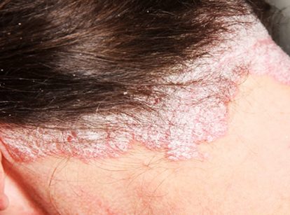 Scalp and Hair Disorder Treatment Program