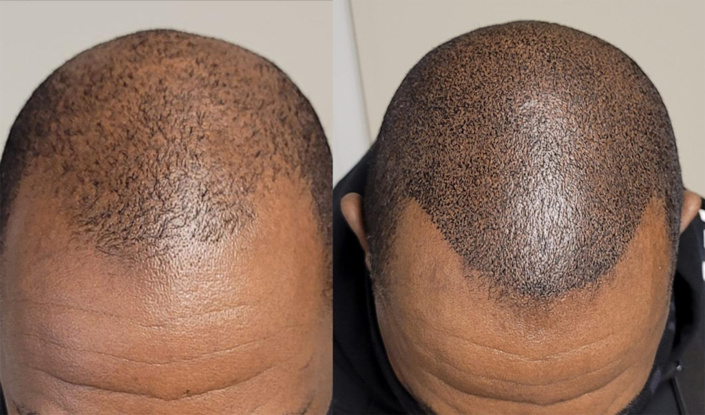 Before and After pictures of client after using one of our treatment programs.